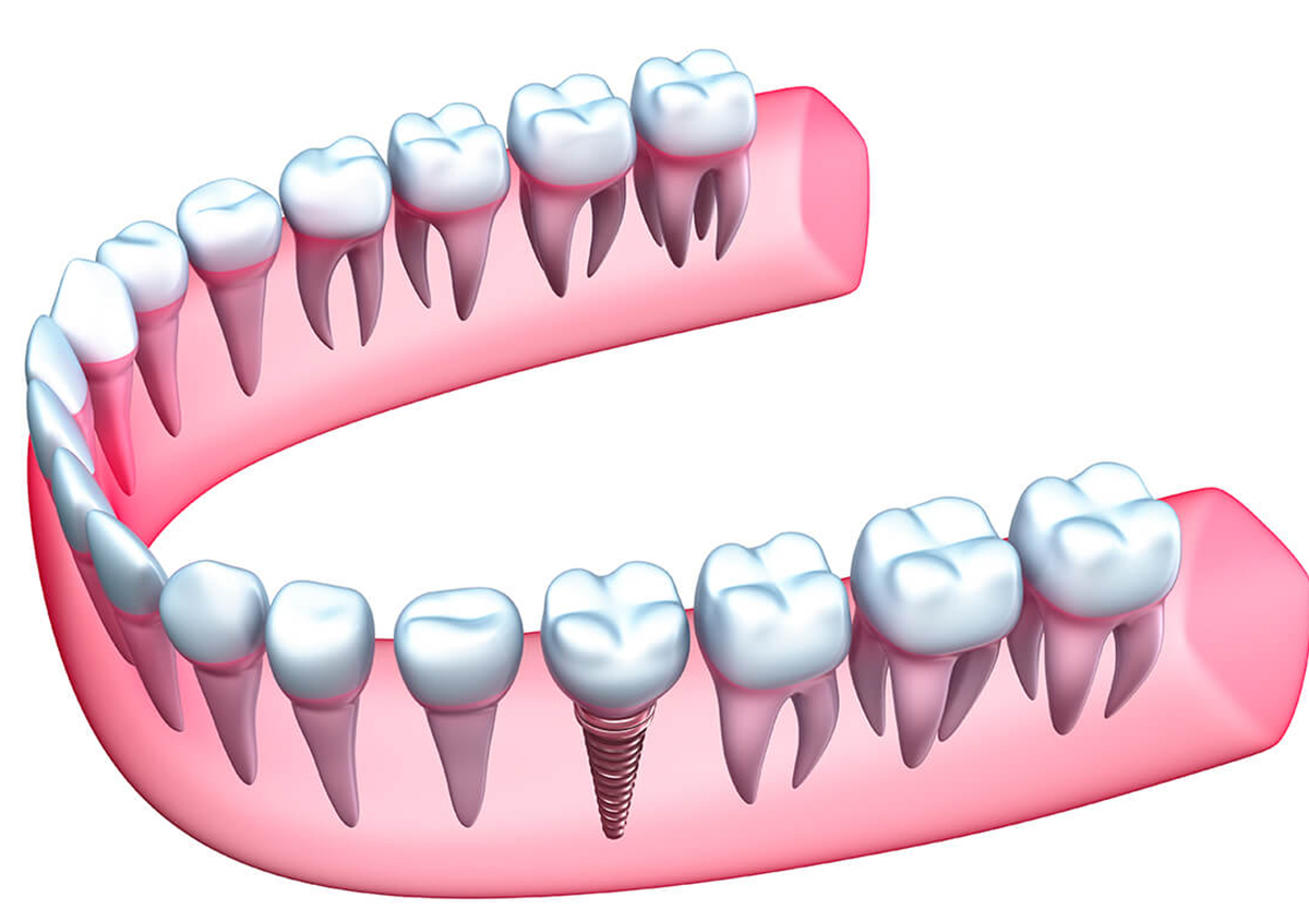 Benefits of Dental Implants in Hunt Valley MD Area