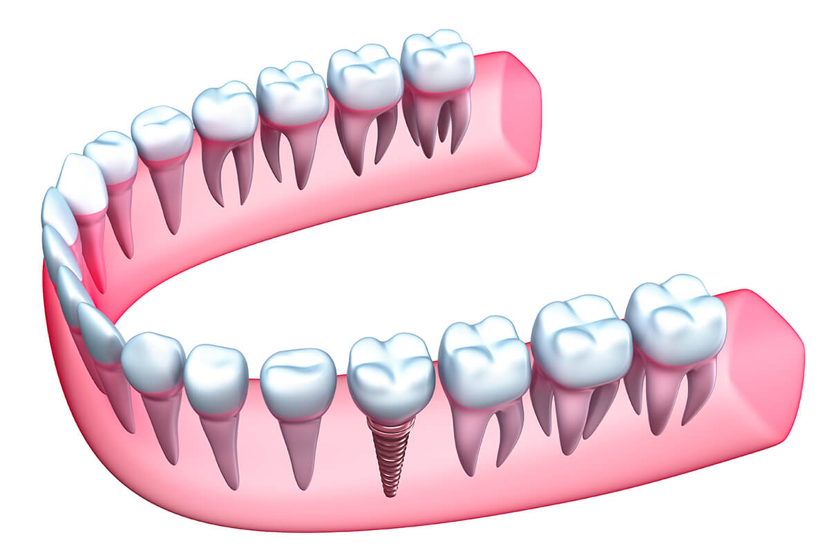 Benefits of Dental Implants over other Teeth Replacements
