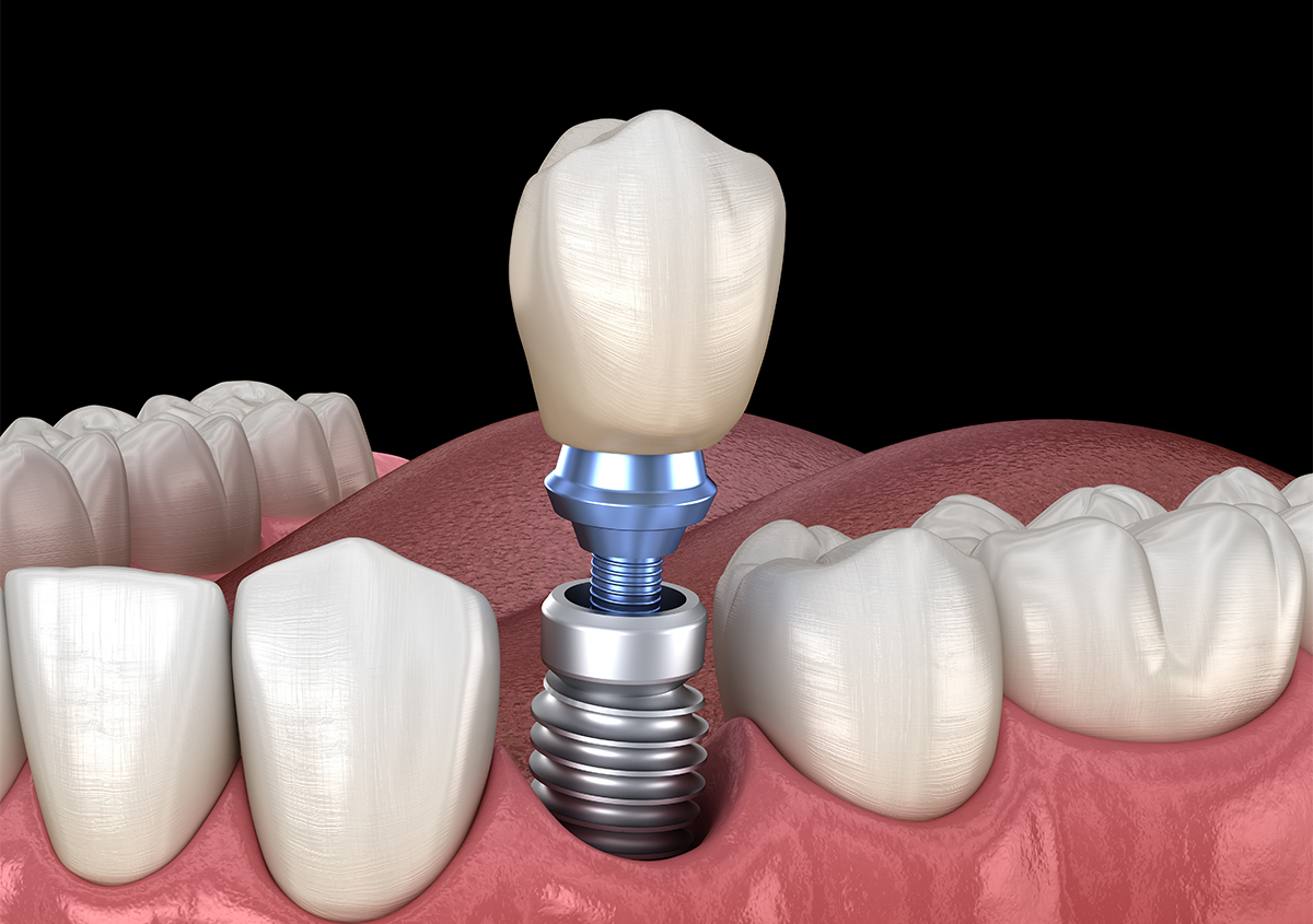 After Care for Dental Implants in Hunt Valley MD Area