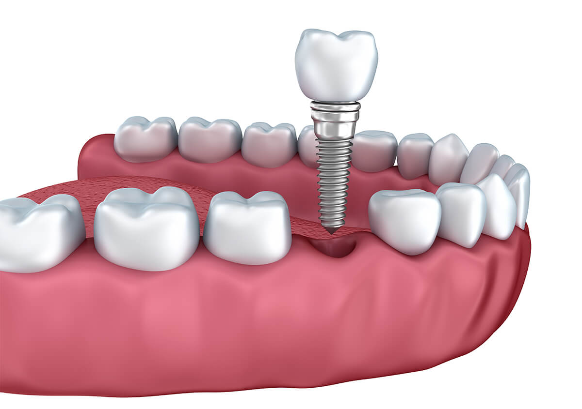 Dental Implant Services in Hunt Valley TN Area